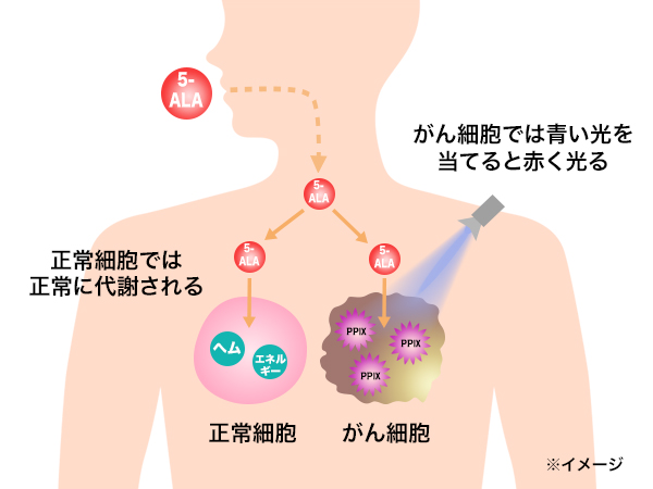 一言で伝えきれない5-ALAの魅力 医療分野での応用が広がる5-ALA