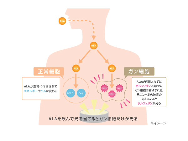 ALAの不思議な魅力 ｰがん細胞が光る？ｰ