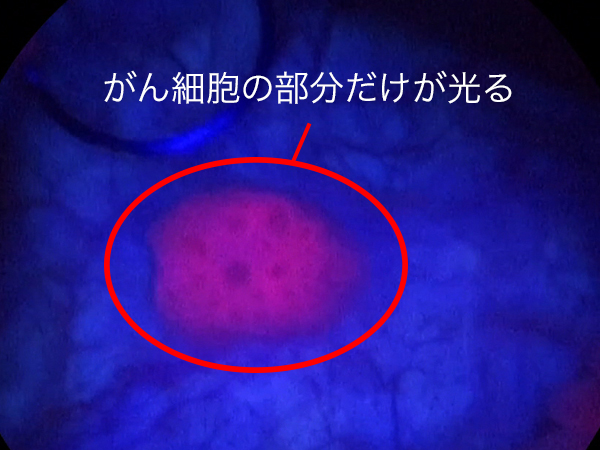 膀胱がん手術画像（光線力学診断)